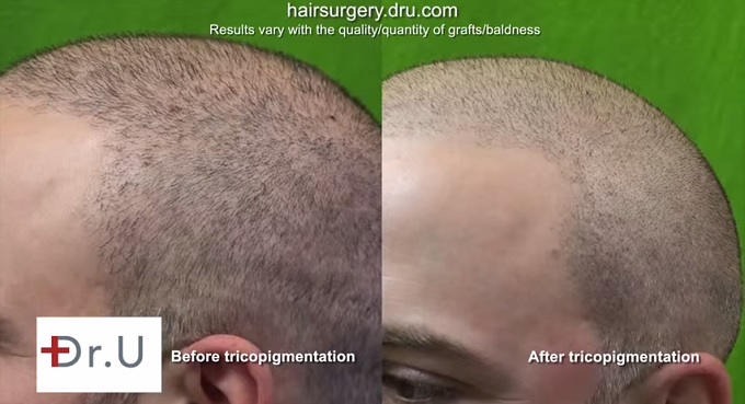 Scalp Pigmentation| SMP via Trichopigmentation - Male Patient's Temples