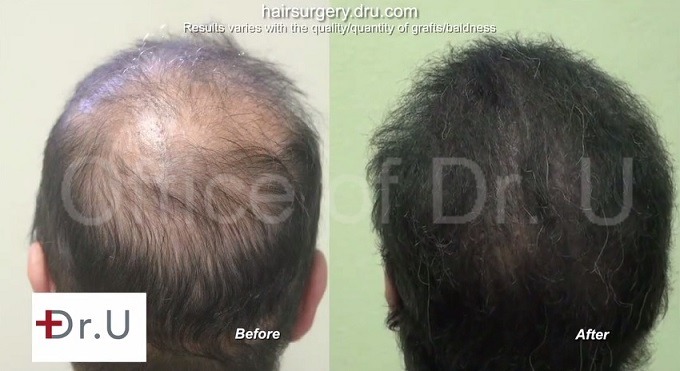 https://www.dermhairclinic.com/wp-content/uploads/2015/03/crown-restoration-beard-hair-grafts.jpg