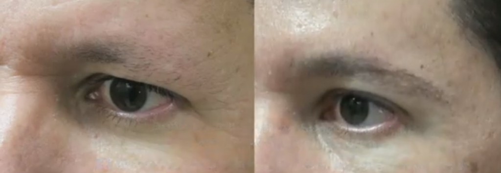 versatility of types of grafts extracted by UGraft FUE hair transplant in los angeles allows for use of leg hair in the creation of most natural looking eyebrows in this patient- Left Side View