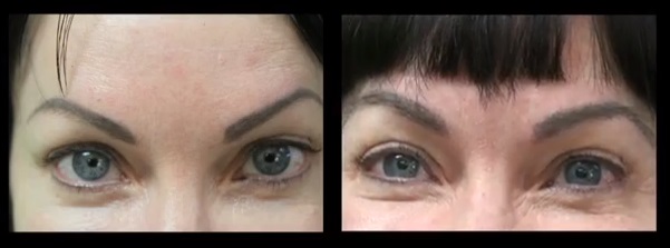 Los Angeles hair restoration patient of Dr U, before and after Eyebrow Transplant using fine nape hair