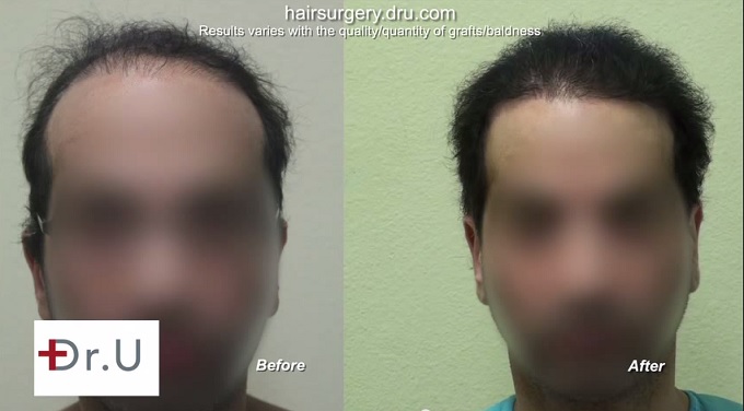 Body Hair Transplant Surgery| 11,000 Grafts - Front Facial View