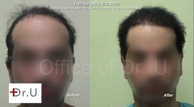 hairline and temple restoration|results after body hair transplant