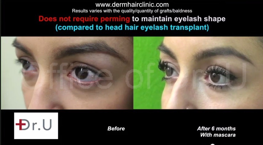 Los Angeles hair restoration patient of Dr U, before and after Eyelash Transplant using leg hair