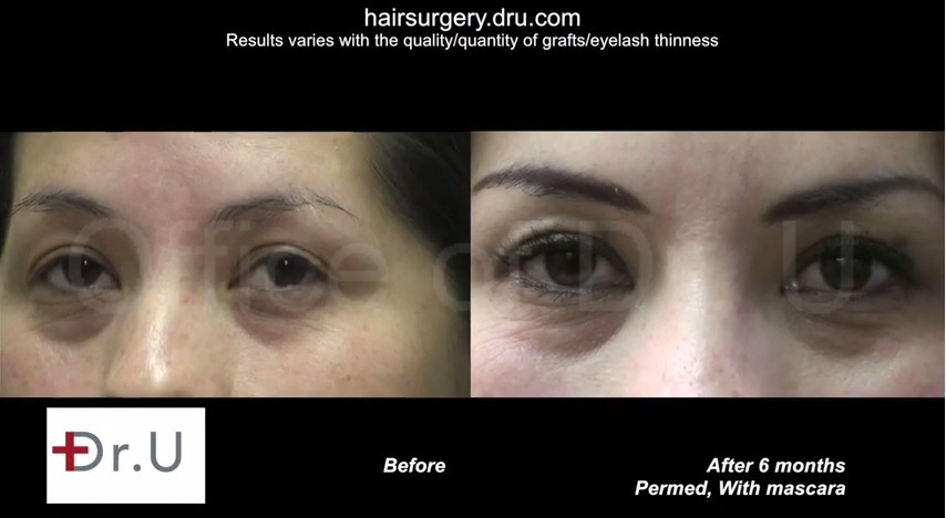 Nape Hair Grafts| Eyelash Transplantation