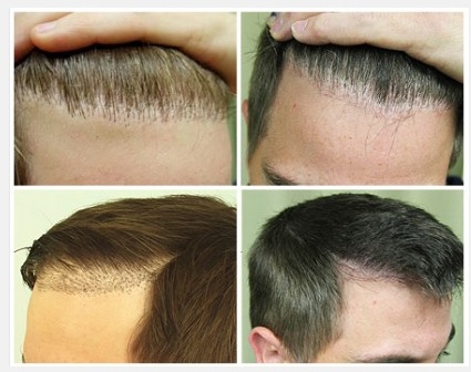 Before and After Hair Restoration Repair for Past Hair Surgeries Using UGraft - Pluggy hairline or Doll's hairline