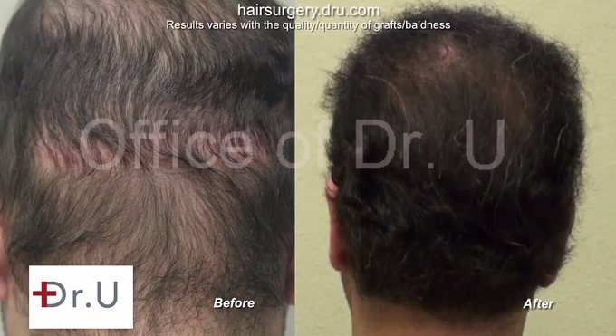 Strip Scar Concealed| Insertions of Body and Head Hair