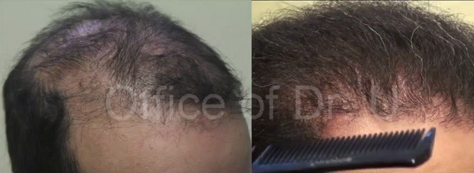 https://www.dermhairclinic.com/wp-content/uploads/2015/03/temple-restoration-before-after1.jpg