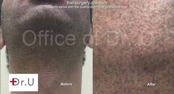 Beard Hair Transplant| Wound Healing Results on Patient's Face