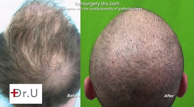 Crown Restoration With Beard Hair| Comparison Crown Restoration With Beard Hair| Comparison