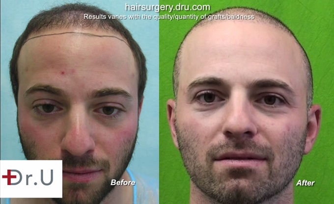 Full Face View| Body Hair Transplant Patient Before & After Full Face View| Body Hair Transplant Patient Before & After