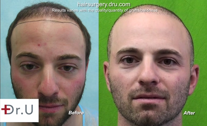 Full Face View| Body Hair Transplant Patient Before & After