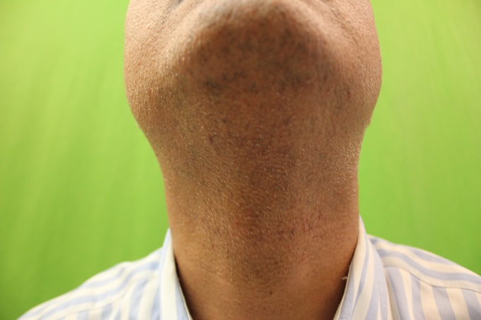UGraft Hair Restoration Using Facial Hair, Donor area at 6 months after over 4000 grafts extraction by Ugraft