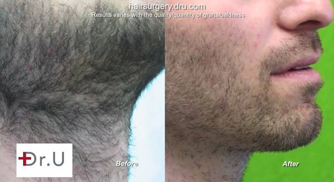 Body to beard hair transplant for a better match in color and texture Body to beard hair transplant for a better match in color and texture