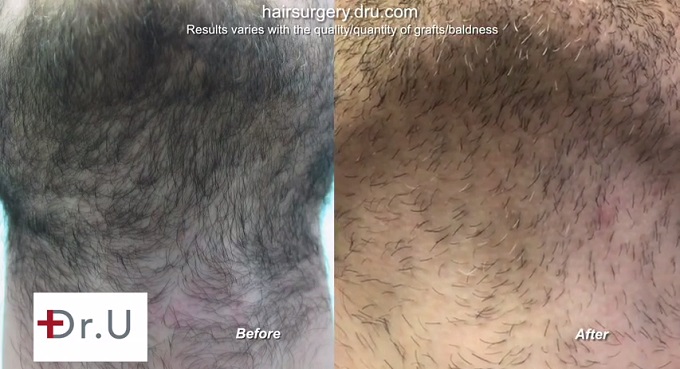 Pristine Beard Donor Healing|Before & After