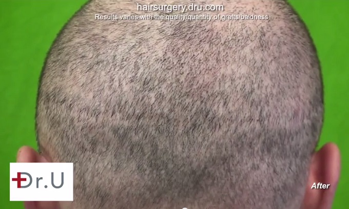 Strip Scar Coverage| Patient's Buzz Cut 