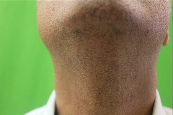 chin-area-close-up.jpg