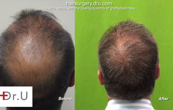 Crown coverage by beard hair to head transplant - Patient Before and After