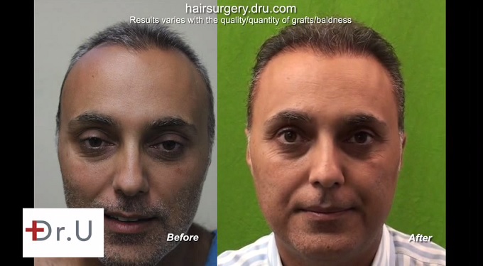 View of Patient's New Hairline |Before and After Hair Transplant Repair