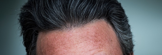 Result of Pluggy Hairline and Hair Transplant Repair Using UGraft FUE