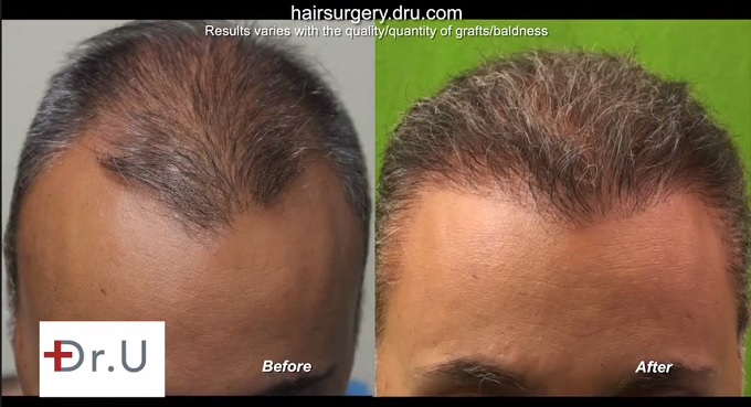 Before and After Comparison| New Hairline Following BHT Repair