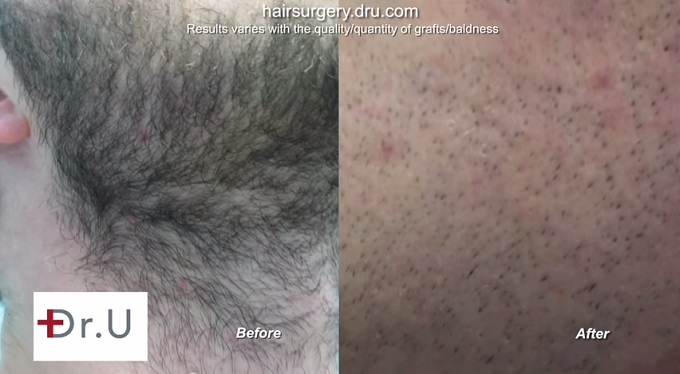 UGraft Hair Restoration Using Facial Hair, Donor area at 6 months after over 4500 grafts extraction by Ugraft