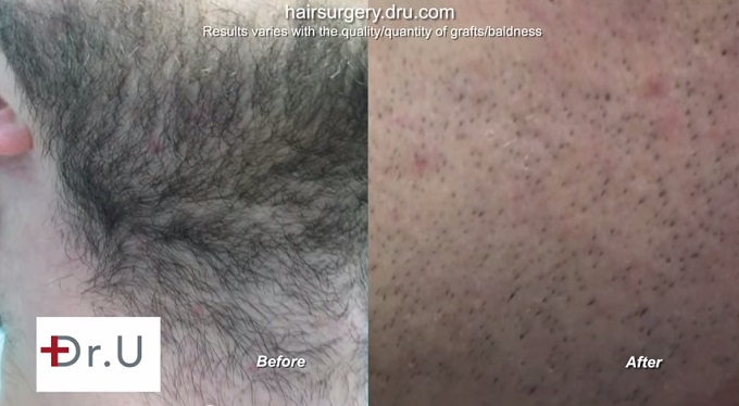 UGraft Hair Restoration Using Facial Hair, Donor area at 6 months after over 4500 grafts extraction by Ugraft UGraft Hair Restoration Using Facial Hair, Donor area at 6 months after over 4500 grafts extraction by Ugraft