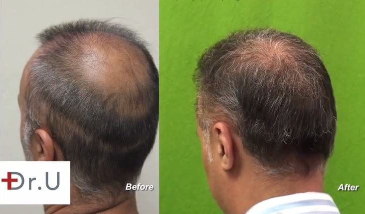 Strip Scar Repair |Body Hair Grafts|Left Side of Head