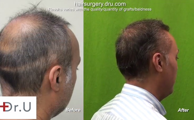 UGraft beard hair to head transplant repair - 8000 grafts Results of Graft Insertion into Strip Scar