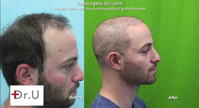 hair transplant corrections with UGraft FUE enabled a buzz cut for a fuller look