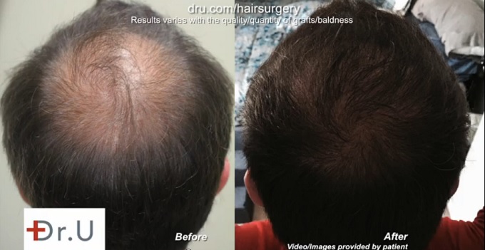 Crown Restoration| Results of Beard Hair to Head Transplant