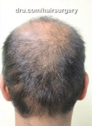 Excessive FUE donor harvesting and head hair donor depletion Seen on Patient