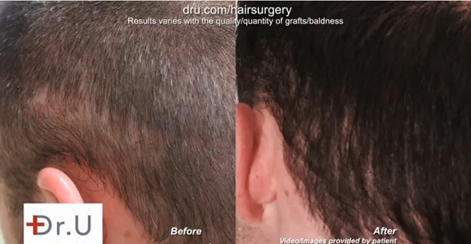 Repair of Strip Scar| Left Side of Patient's Scalp