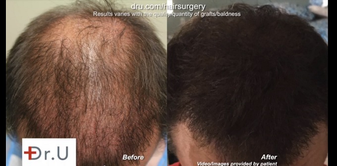 Head and Beard Follicles Used for 4500 UGraft Surgery - 12 Months Later