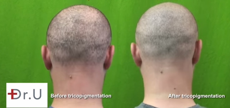 Strip Scar Repair| SMP - Trichopigmentation