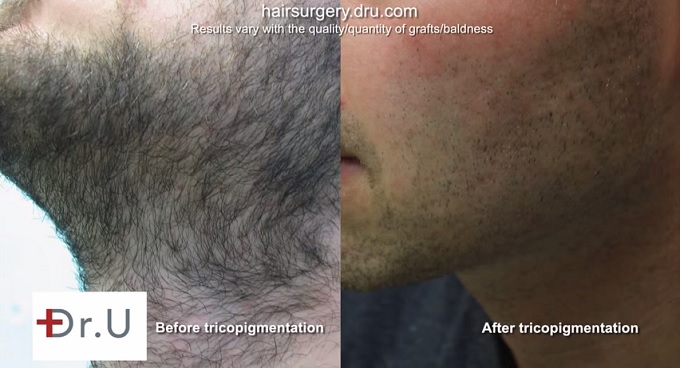 Beard Area Before and After Tricopigmentation