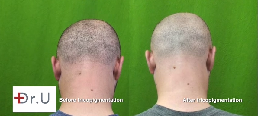 Strip Scar Repair and Scalp Pigmentation