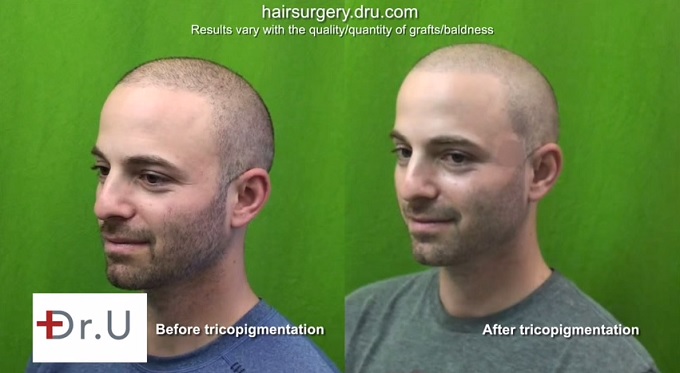 Hair Density Improved with Body Hair Transplantation & Trichopigmentation Before and After SMP via Tricopigmentation