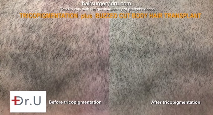 Close Up View| Scalp Pigmentation via Trichopigmentation