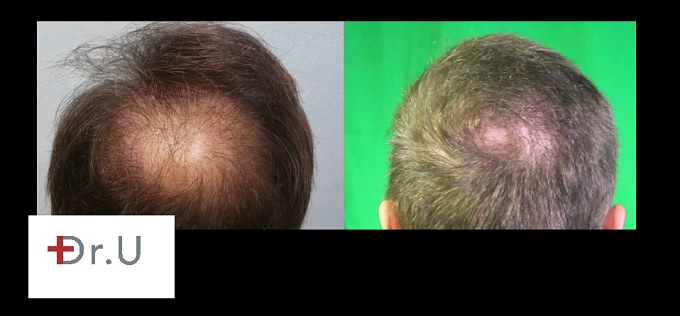 Restoration of Bald Crown| Body Hair Transplant Grafts