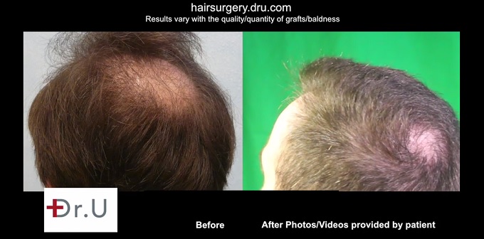 crown-hair-restored-body-hair-transplant-patient.jpg