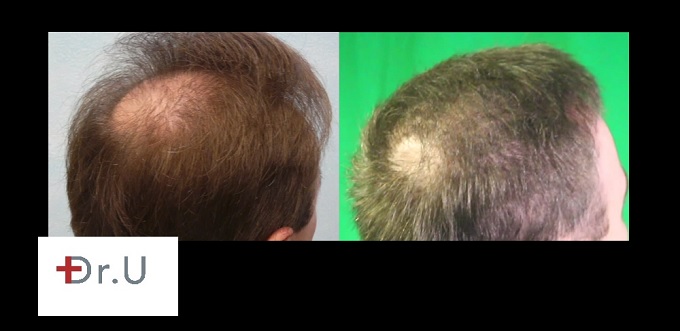 Crown Hair Restoration| Side View
