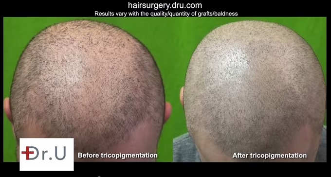 Exploring Hair Loss Concealers as Temporary Solutions . Trichopigmentation and UGraft Beard Hair Transplant Growth