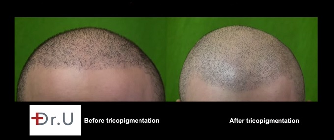 Hairline| Scalp Micropigmentation Via Trichopigmentation