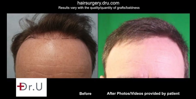 BHT Surgery Repairs Poor Strip Surgery Results| Advancing the Temples and Hairline