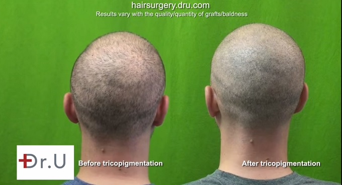 Back of Head| Tricopigmentation Scalp Pigmentation Results