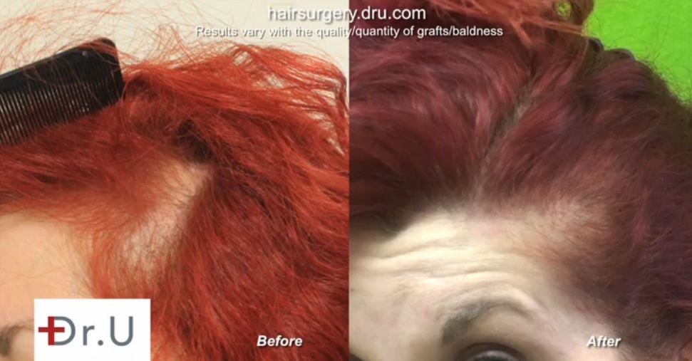 Female hair restoration candidate before and after traction alopecia surgical treatment by UGraft FUE hair transplant