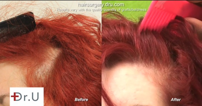 UGraft Hair Restoration for Traction Alopecia - before and after photo