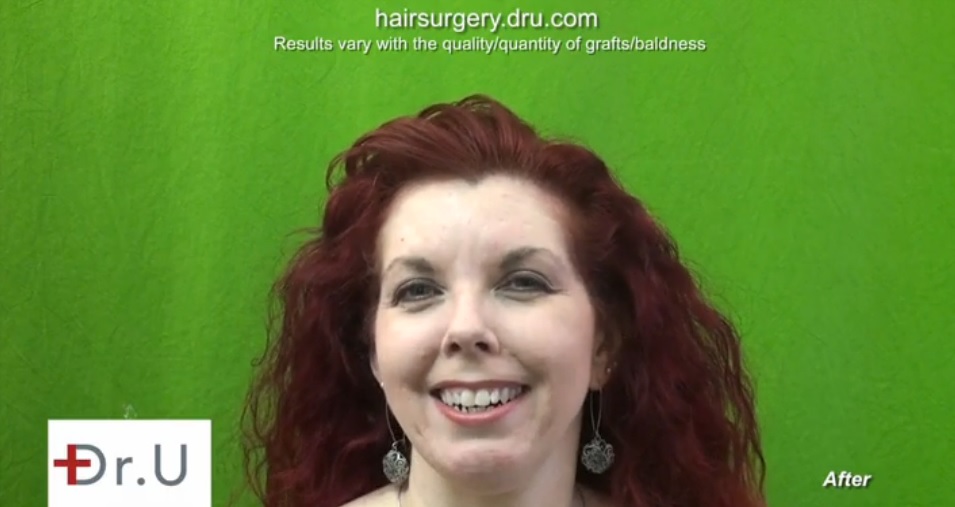 Happy Patient After Her Traction Alopecia Procedure