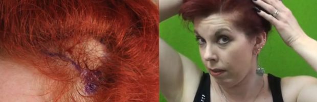 can traction alopecia be reversed