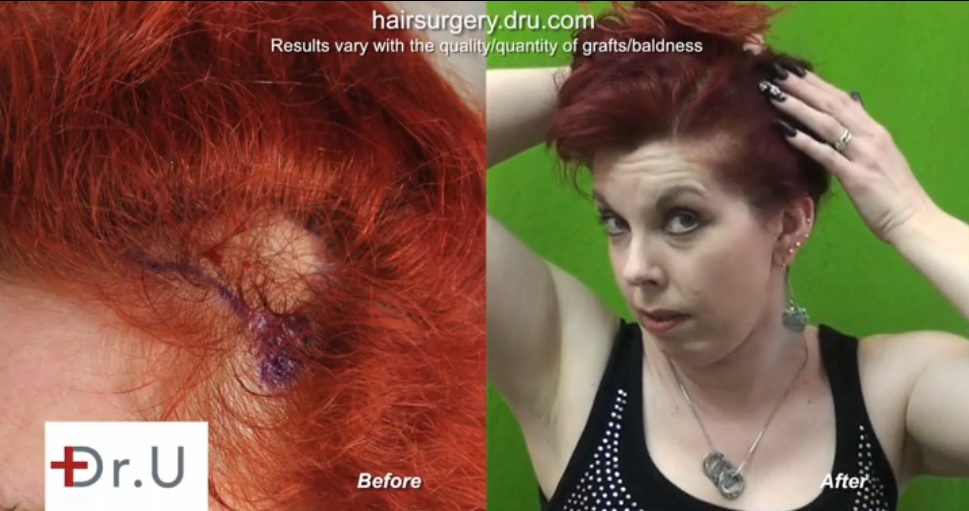 Outcome of Traction Alopecia Surgery| Pulling Hair Up